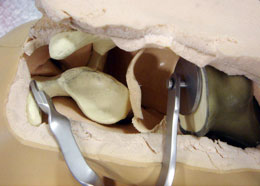 Glenoid Spreader